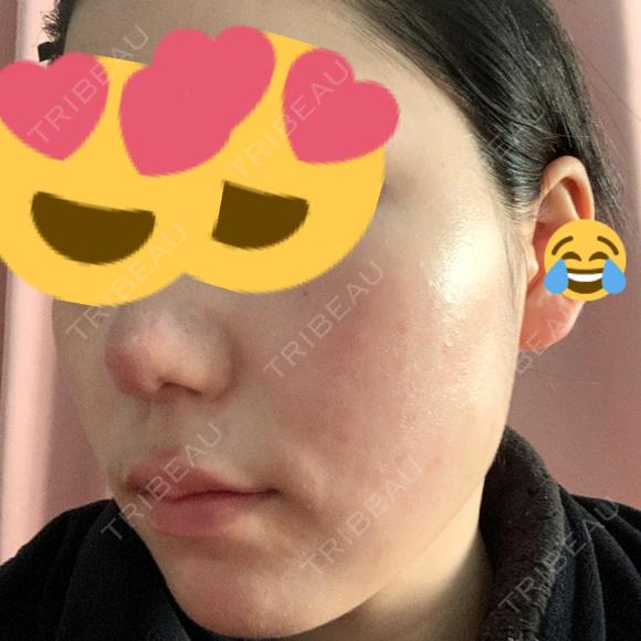 その他（肌） / ポテンツァ LOUIS CLINIC 二子玉川院【ルイクリニック】 AFTER メイン用
