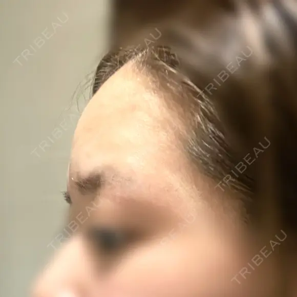 ヒアルロン酸注入（額） 心斎橋形成外科スキンケアクリニック AFTER メイン用