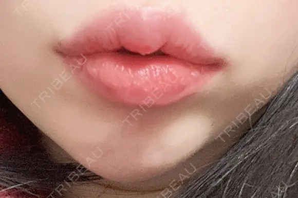 ヒアルロン酸注入（唇） 湘南美容クリニック 大阪堺東院 DAY 9 メイン用