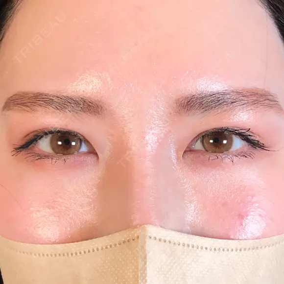 二重埋没 アリエル美容クリニック 郡山院 AFTER メイン用