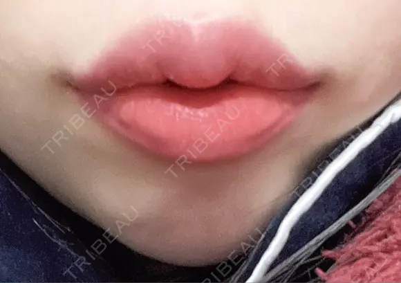 ヒアルロン酸注入（唇） 湘南美容クリニック 大阪堺東院 DAY 11 メイン用