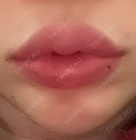 ヒアルロン酸注入（唇） 湘南美容クリニック 大阪堺東院 AFTER メイン用