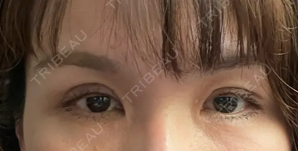 二重切開 / 上まぶたたるみ取り 心斎橋形成外科スキンケアクリニック DAY 13 メイン用