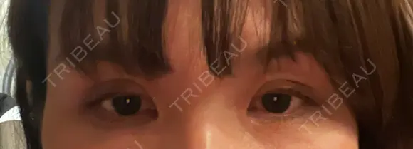 二重切開 / 上まぶたたるみ取り 心斎橋形成外科スキンケアクリニック DAY 15 メイン用