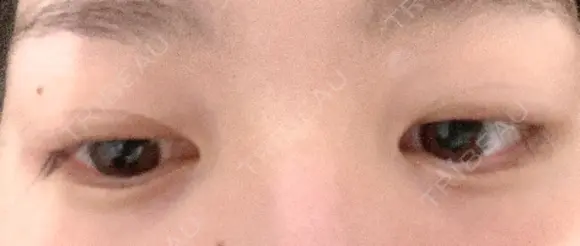 二重埋没 湘南美容クリニック 藤沢院 DAY 700 メイン用