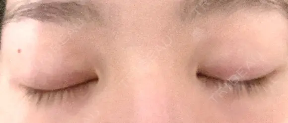 二重埋没 湘南美容クリニック 藤沢院 DAY 700 メイン用