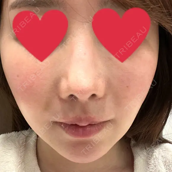 鼻翼基部形成（貴族手術） 新宿ラクル美容外科クリニック 新宿院 DAY 9 メイン用