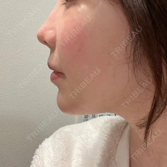 鼻翼基部形成（貴族手術） 新宿ラクル美容外科クリニック 新宿院 DAY 9 メイン用