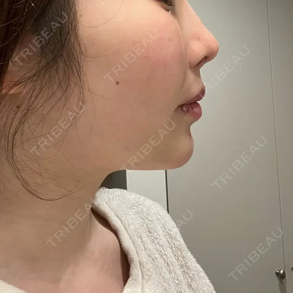 鼻翼基部形成（貴族手術） 新宿ラクル美容外科クリニック 新宿院 DAY 9 メイン用