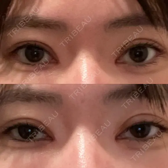 二重切開 / 目頭切開 聖心美容クリニック 札幌院 AFTER メイン用