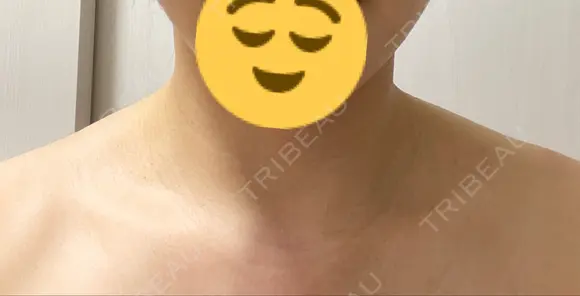 ボトックス（ふくらはぎ） / ボトックス（肩） LOUIS CLINIC 二子玉川院【ルイクリニック】 DAY 0 メイン用