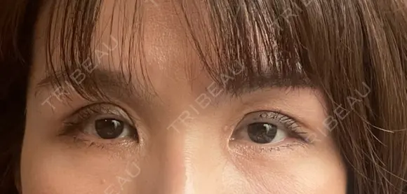 二重切開 / 上まぶたたるみ取り 心斎橋形成外科スキンケアクリニック DAY 17 メイン用