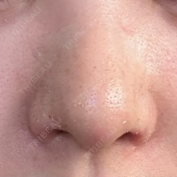 軟骨移植 / 鼻孔縁挙上 / 鼻尖縮小 くさのたろうクリニック DAY 10 メイン用