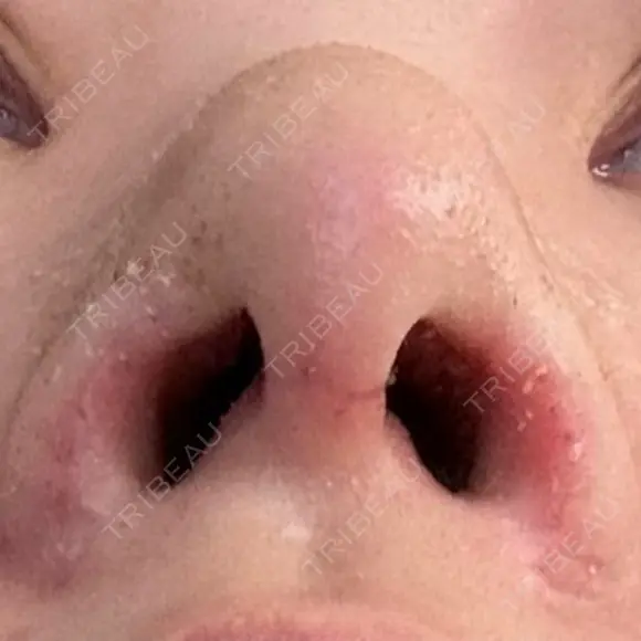 軟骨移植 / 鼻孔縁挙上 / 鼻尖縮小 くさのたろうクリニック DAY 10 メイン用