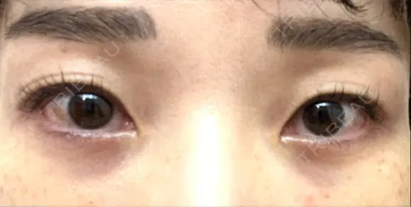 下まぶたの脂肪取り / 脂肪注入（目の下） セオリークリニック DAY 31 メイン用