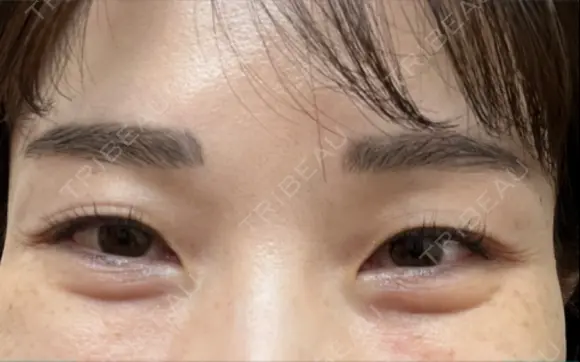 下まぶたの脂肪取り / 脂肪注入（目の下） セオリークリニック DAY 31 メイン用