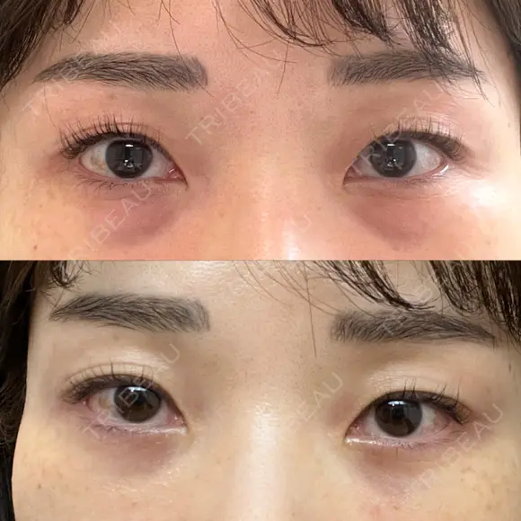 下まぶたの脂肪取り / 脂肪注入（目の下） セオリークリニック DAY 31 メイン用