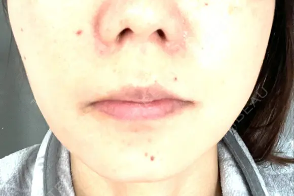 ボトックス（エラ・小顔） TCB東京中央美容外科 京都駅前院 DAY 90 メイン用