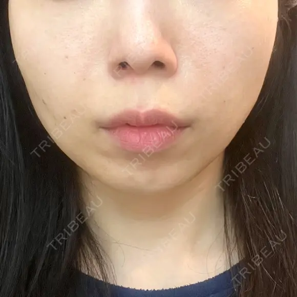 糸リフト / ボトックス（エラ・小顔） / ヒアルロン酸注入（頬） TCB東京中央美容外科 銀座有楽町院 DAY 1 メイン用
