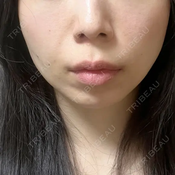 糸リフト / ボトックス（エラ・小顔） / ヒアルロン酸注入（頬） TCB東京中央美容外科 銀座有楽町院 DAY 2 メイン用