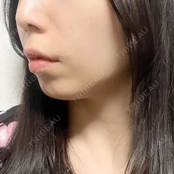 糸リフト / ボトックス（エラ・小顔） / ヒアルロン酸注入（頬） TCB東京中央美容外科 銀座有楽町院 DAY 0 メイン用