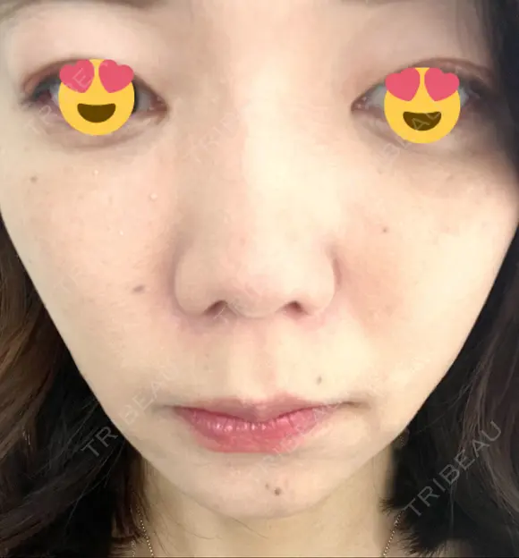 ボトックス（エラ・小顔） TCB東京中央美容外科 京都駅前院 DAY 91 メイン用