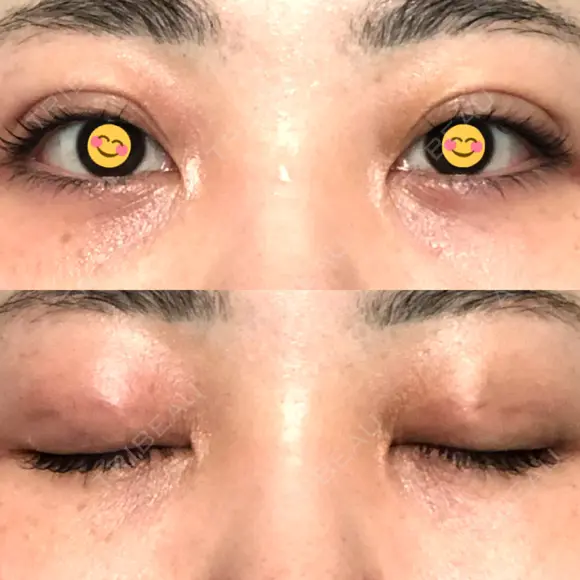 二重埋没 オーキッド美容クリニック東京御徒町 DAY 2 メイン用