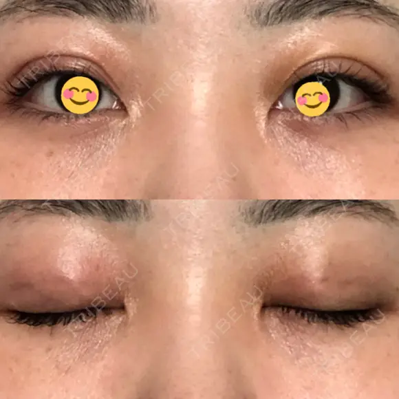 二重埋没 オーキッド美容クリニック東京御徒町 DAY 3 メイン用