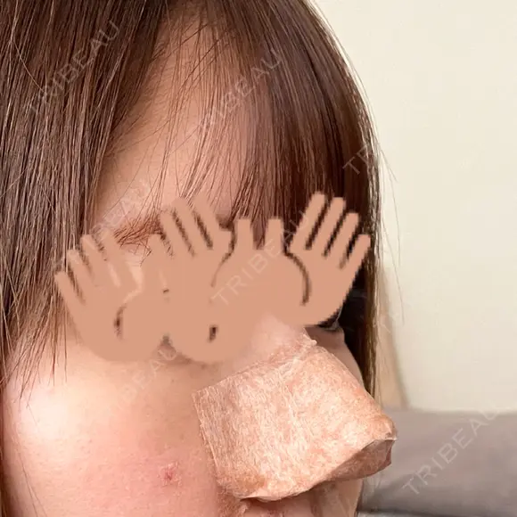 軟骨移植 フェアクリニック川口 DAY 3 メイン用