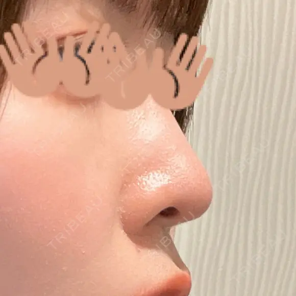 軟骨移植 フェアクリニック川口 AFTER メイン用
