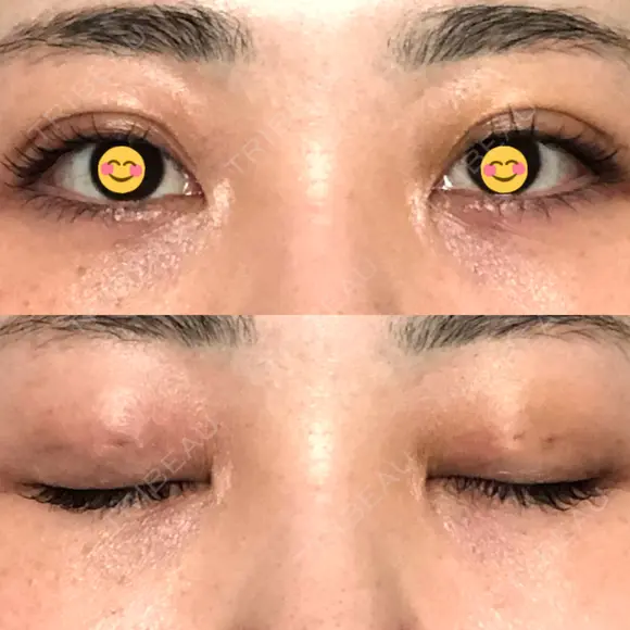 二重埋没 オーキッド美容クリニック東京御徒町 DAY 4 メイン用