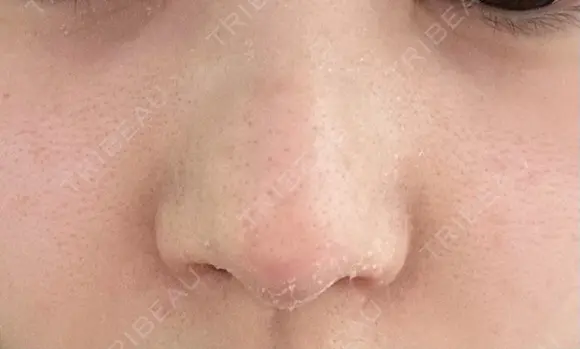 軟骨移植 / 鼻孔縁挙上 / 鼻尖縮小 くさのたろうクリニック DAY 14 メイン用