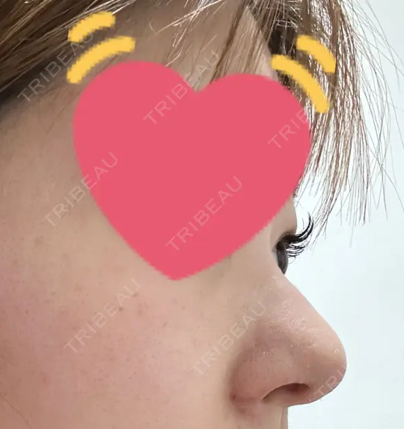 軟骨移植 / 鼻孔縁挙上 / 鼻尖縮小 くさのたろうクリニック DAY 14 メイン用