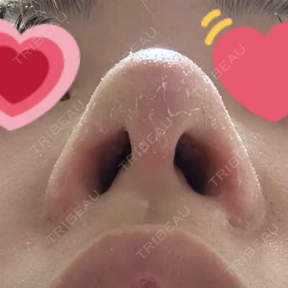 軟骨移植 / 鼻孔縁挙上 / 鼻尖縮小 くさのたろうクリニック DAY 14 メイン用