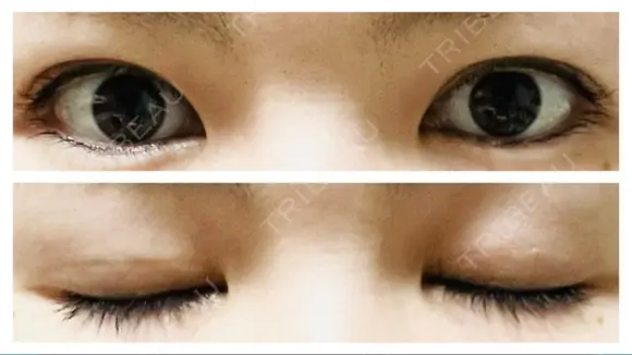 二重埋没 アリエル美容クリニック 郡山院 AFTER メイン用