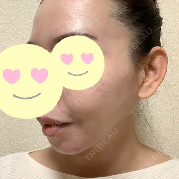 脂肪吸引（顔） / 脂肪注入（肌） / ヒアルロン酸注入（あご） / ボトックス（エラ・小顔） / ダーマペン Mods Clinic（モッズクリニック） 大阪院 DAY 91 メイン用