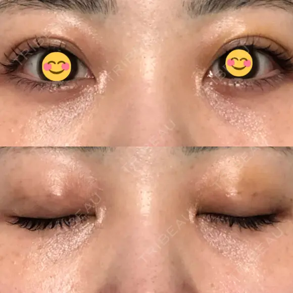 二重埋没 オーキッド美容クリニック東京御徒町 DAY 5 メイン用