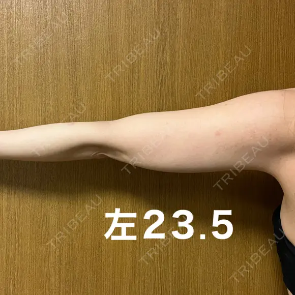 脂肪冷却（二の腕） みずほクリニック DAY 47 メイン用