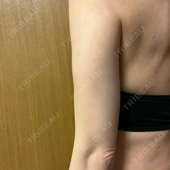 脂肪冷却（二の腕） みずほクリニック DAY 47 メイン用