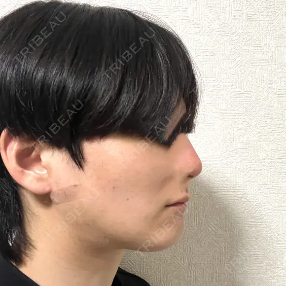 脂肪吸引（顔） 石倉クリニック 水戸院 DAY 10 メイン用