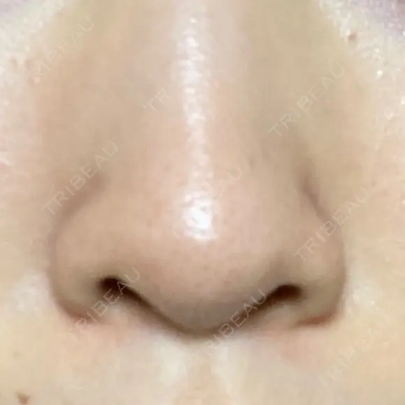 毛穴洗浄（ハイドラフェイシャルなど） / ニードルRF（ポテンツァなど） Zetith Beauty Clinic 銀座院 DAY 10 メイン用