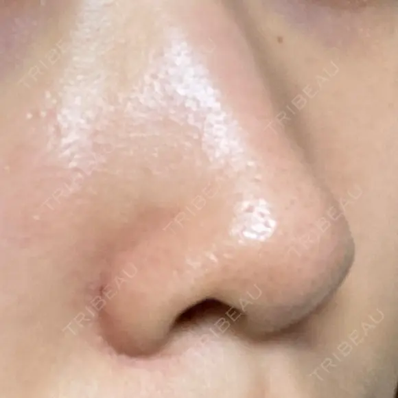 毛穴洗浄（ハイドラフェイシャルなど） / ニードルRF（ポテンツァなど） Zetith Beauty Clinic 銀座院 DAY 10 メイン用