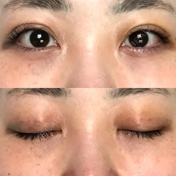 二重埋没 オーキッド美容クリニック東京御徒町 DAY 6 メイン用