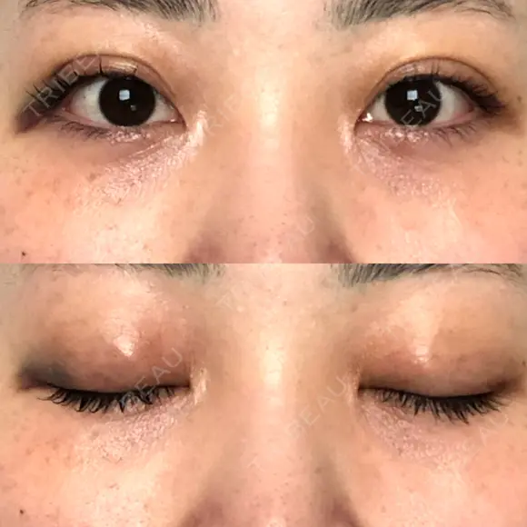 二重埋没 オーキッド美容クリニック東京御徒町 DAY 7 メイン用