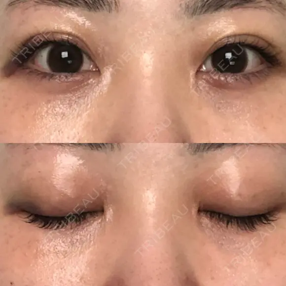 二重埋没 オーキッド美容クリニック東京御徒町 DAY 8 メイン用