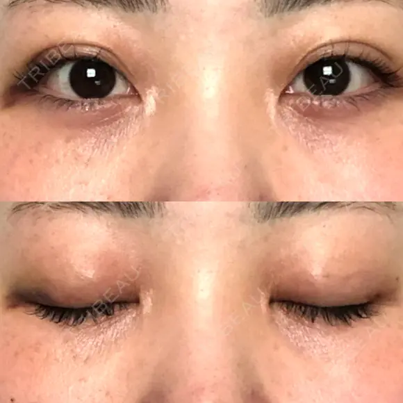 二重埋没 オーキッド美容クリニック東京御徒町 DAY 9 メイン用