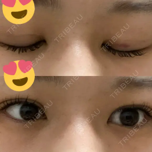 二重埋没 神戸中央クリニック美容外科 AFTER メイン用