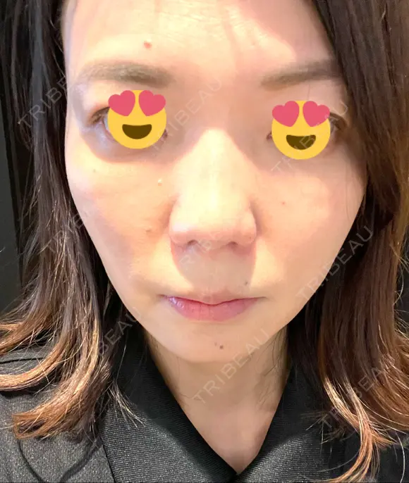 ボトックス（エラ・小顔） TCB東京中央美容外科 京都駅前院 DAY 98 メイン用