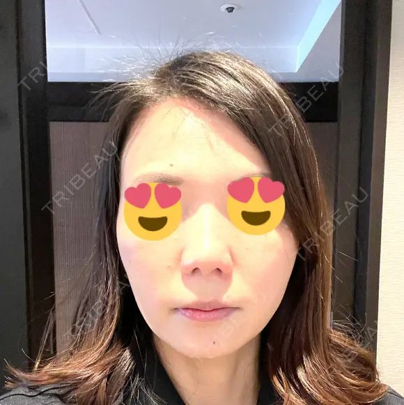 ボトックス（エラ・小顔） TCB東京中央美容外科 京都駅前院 DAY 98 メイン用