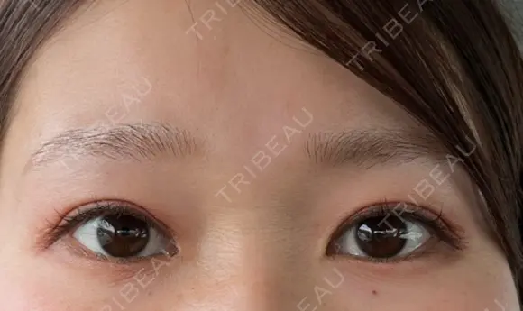 二重切開 / 目元修正 こまちクリニック DAY 154 メイン用